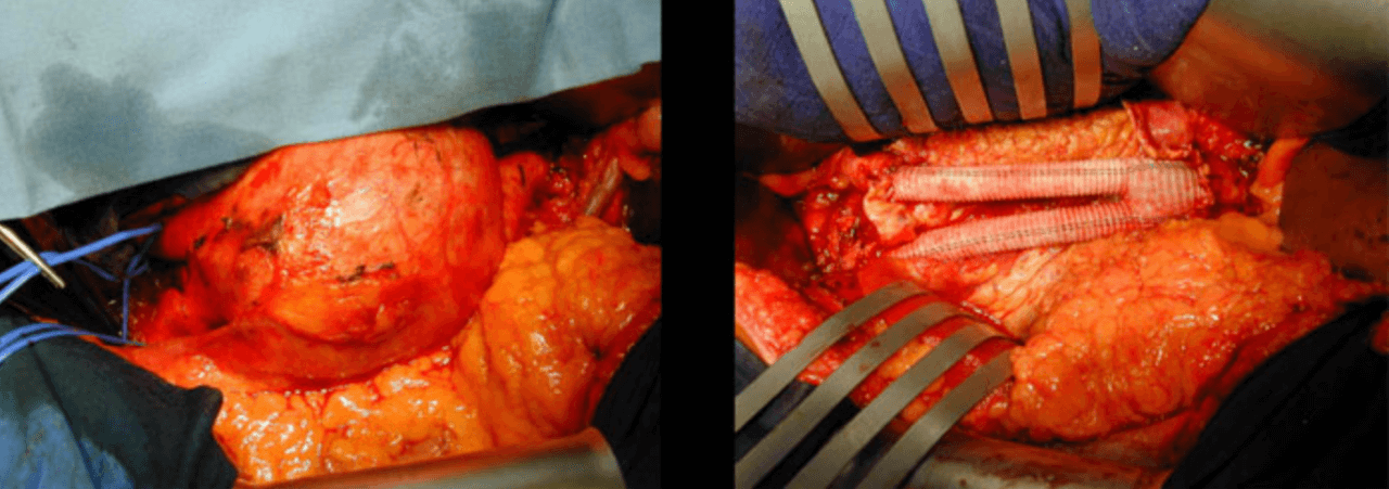 Chirurgie d'une Aorte Abdominale
