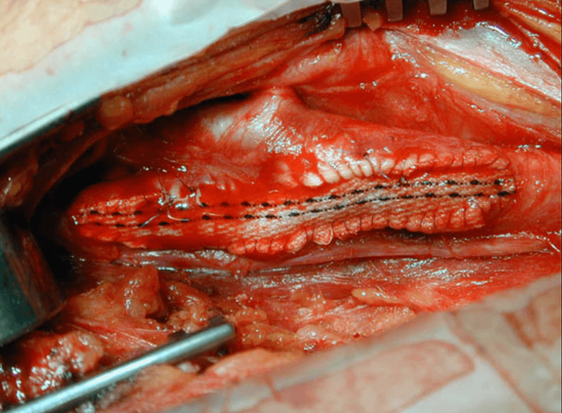 Chirurgie de la carotide