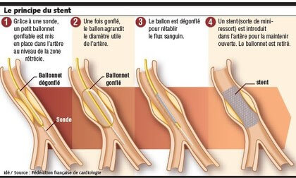 Principe du stent